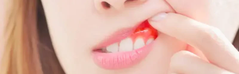 Acute Gingivitis Adalah: Sebab, Gejala & Obat Radang Gusi