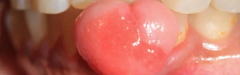 Granuloma Gigi: Pahami Gejala, Bahayanya, Serta Solusi!
