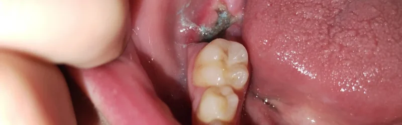 Dry Socket: Gejala dan Pencegahannya